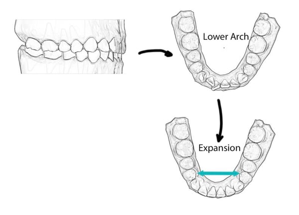 Expansion + ASR-Kombi aus