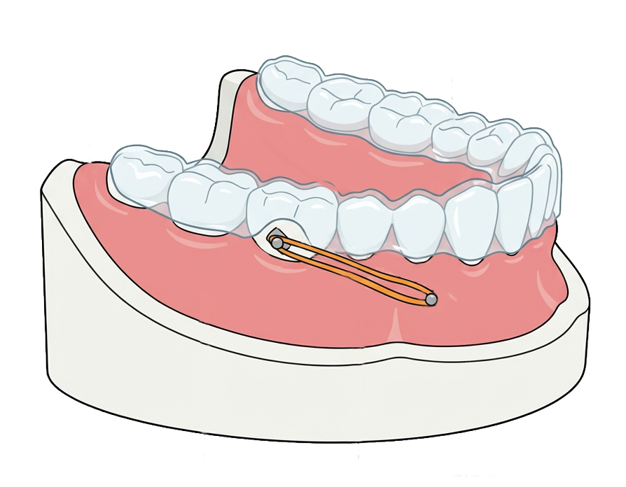 Aligner-Tads-1 Aligner-Tads-1